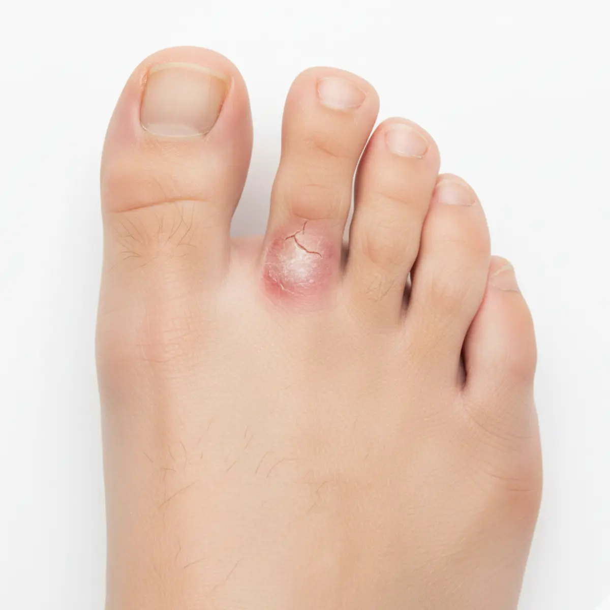 Stopy z objawami grzybicy